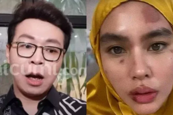 Richard Lee Tanggapi Muka Kartika Putri Alami Ruam sampai Melepuh: Mudah-mudahan Buka Azab